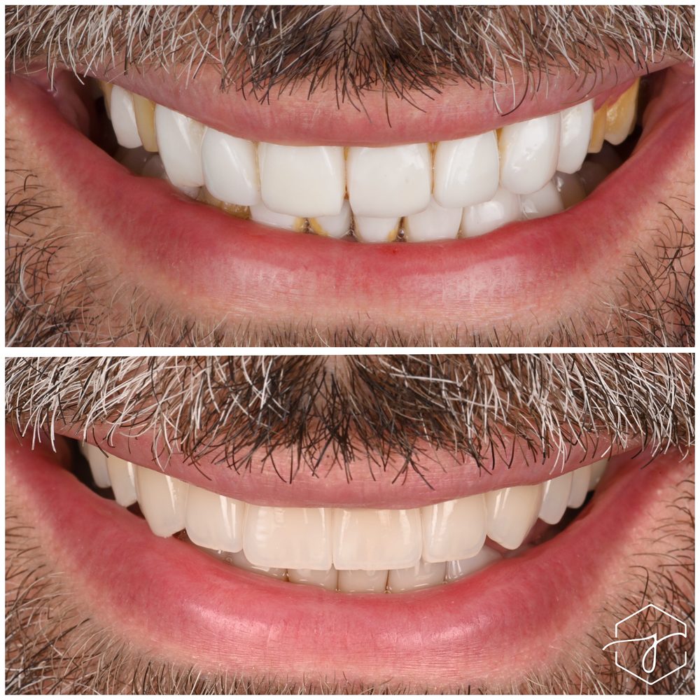 قبل وبعد - حالة تجميل الابتسامة 11