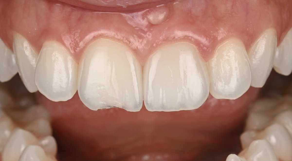 A chipped edge on a central incisor veneer, with early gum inflammation visible above