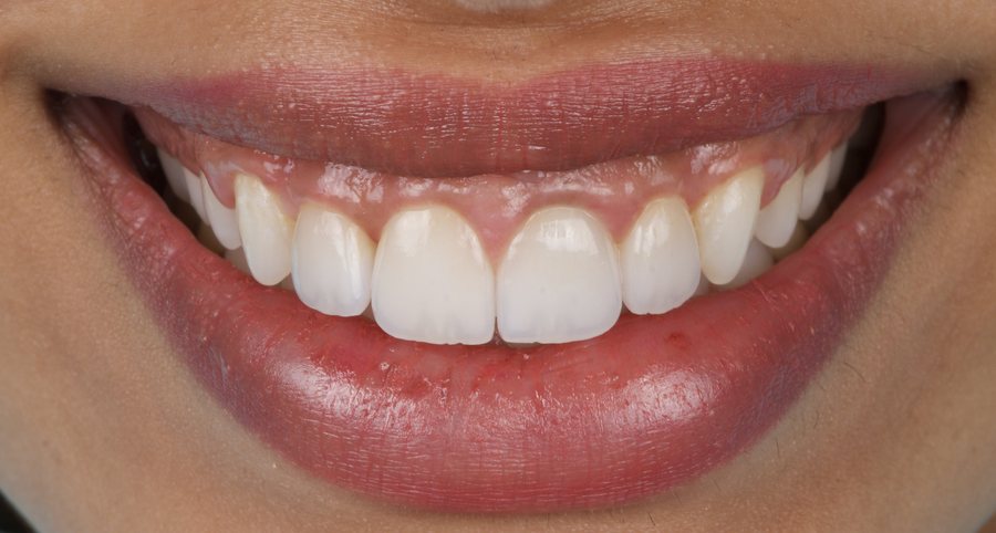 Healthy gum tissue after treatment with a well-fitting crown margin