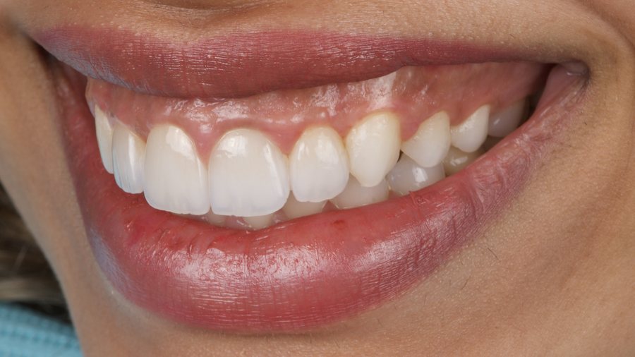 Healthy gum tissue after treatment with a well-fitting crown margin
