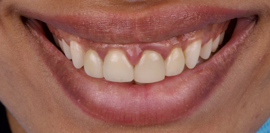 Gum inflammation before treatment of an ill-fitting crown margin