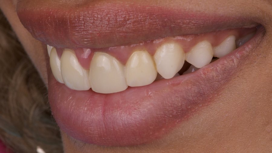 Gum inflammation before treatment of an ill-fitting crown margin