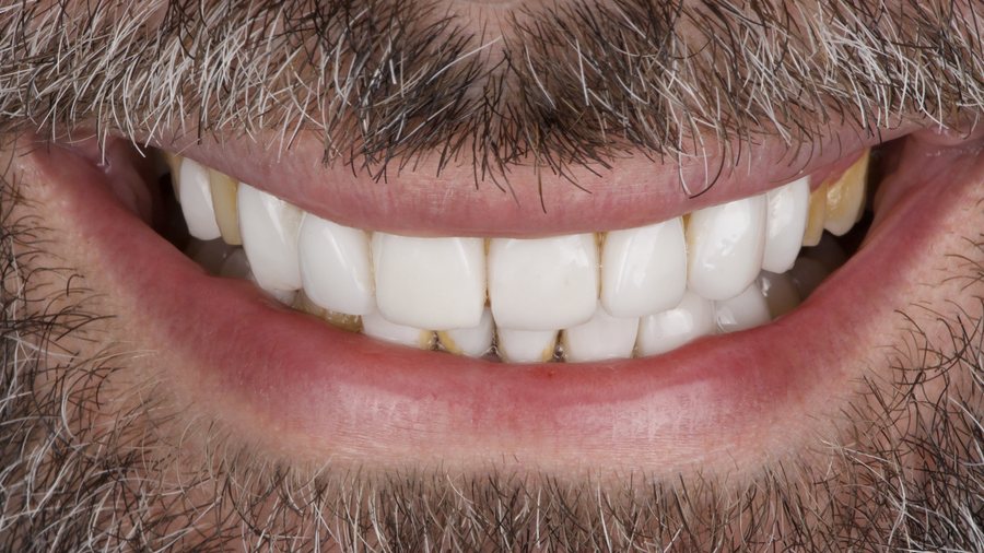 A Hollywood Smile case two years later, showing color mismatch and buildup at the gumline