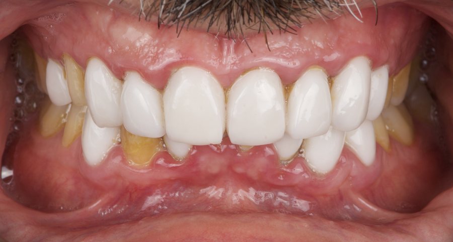Close-up of the same case showing staining on the natural teeth beside mismatched restorations