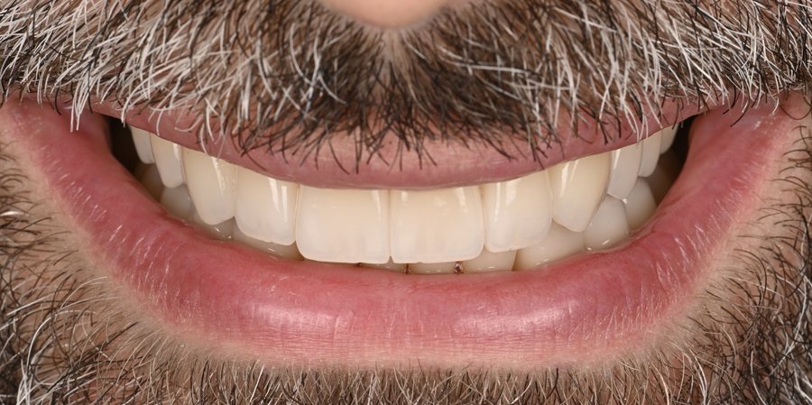The same patient after the failed Hollywood Smile was corrected with a properly planned, well-fitted restoration